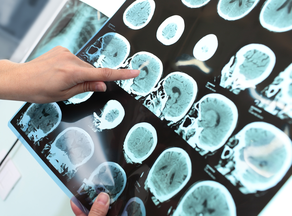 Nyt studie viser: Sådan kan denne aldersgruppe beskytte sig mest muligt mod Alzheimers