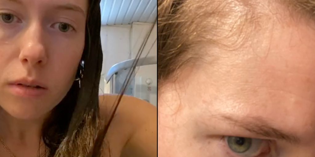 Hendes hår faldt ud i totter: Men hun fik det hele tilbage ved at lave 4 simple ændringer
