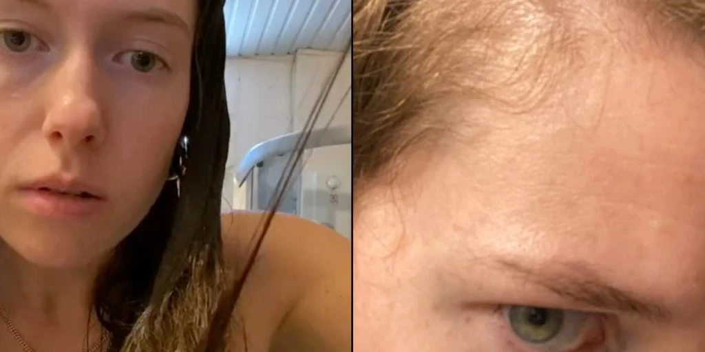 Hendes hår faldt ud i totter: Men hun fik det hele tilbage ved at lave 4 simple ændringer