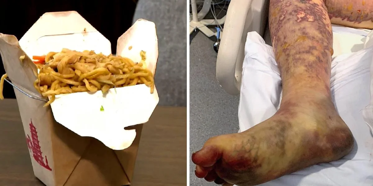 19-årig spiste rester af kinesisk takeaway: Nu har han mistet sine ben og fingre