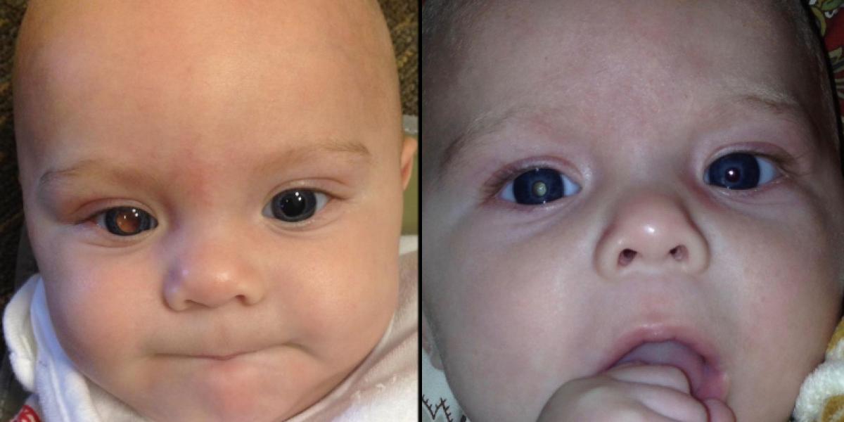 Mor tog billede af fire måneder gammel baby: Så opdagede hun livstruende sygdom