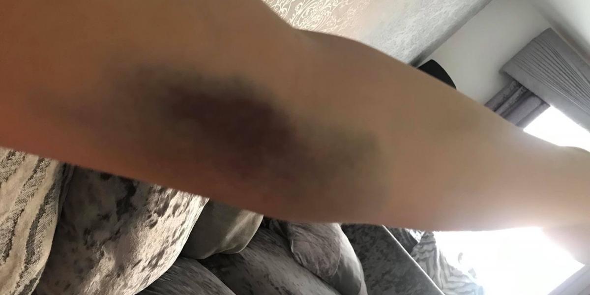 22-årig ung mor gik til lægen med blå mærker – Ugen efter var hun død