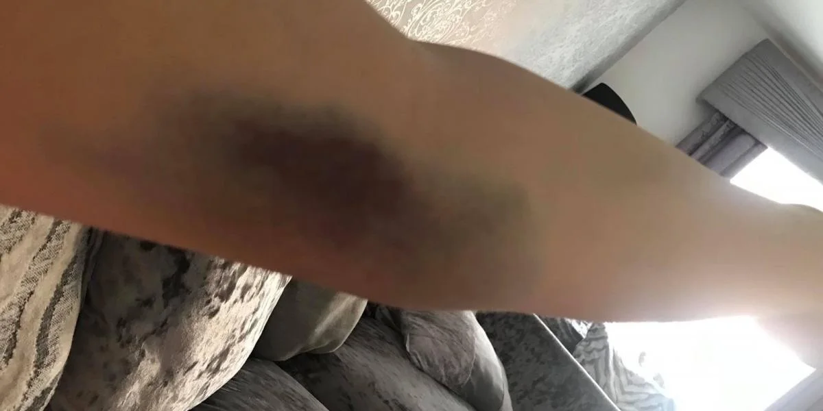 22-årig ung mor gik til lægen med blå mærker – Ugen efter var hun død