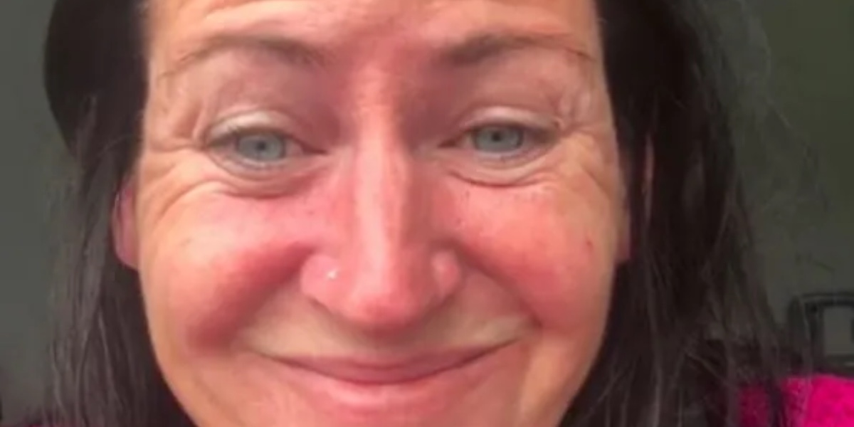 Kvinde får botox for første gang: Nu tror folk ikke, at det er den samme person