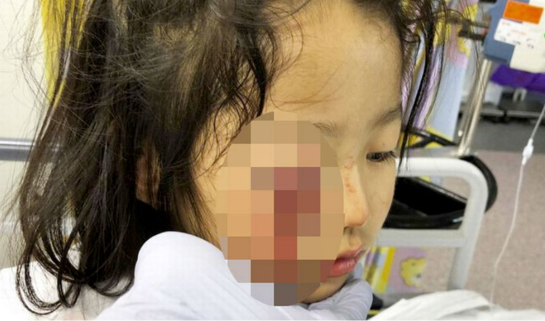 Supermarked dømt til at betale 290.000 kroner, efter 6-årige Cecilia næsten mistede synet på det ene øje