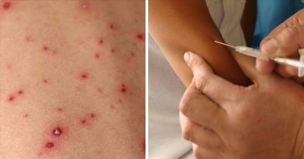 Frygt for udbrud af smitsom sygdom i Danmark: Nu kan alle få vaccine