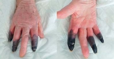 Covid forvandler kvindes fingre sorte efter virussen hærger hendes blodkar