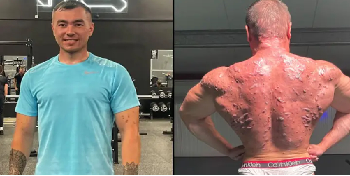 Bodybuilder viser bivirkningerne ved steroider