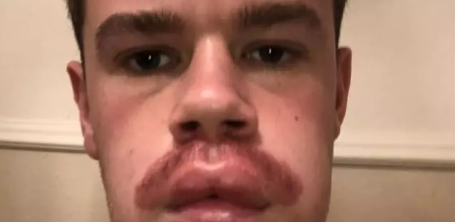 Movember: 23-årig ville farve sit overskæg – Det gik fuldstændig galt