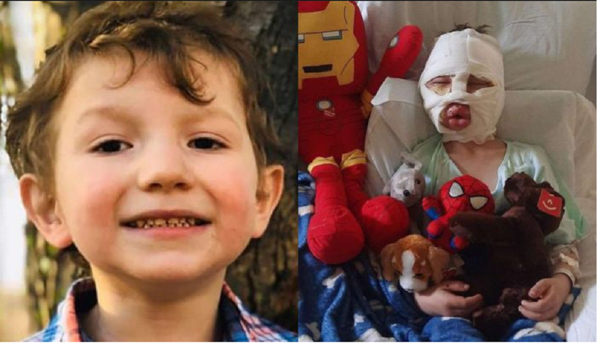 Teenagere satte ild til 6-årig dreng: “Mor hjælp mig, de satte ild til mig