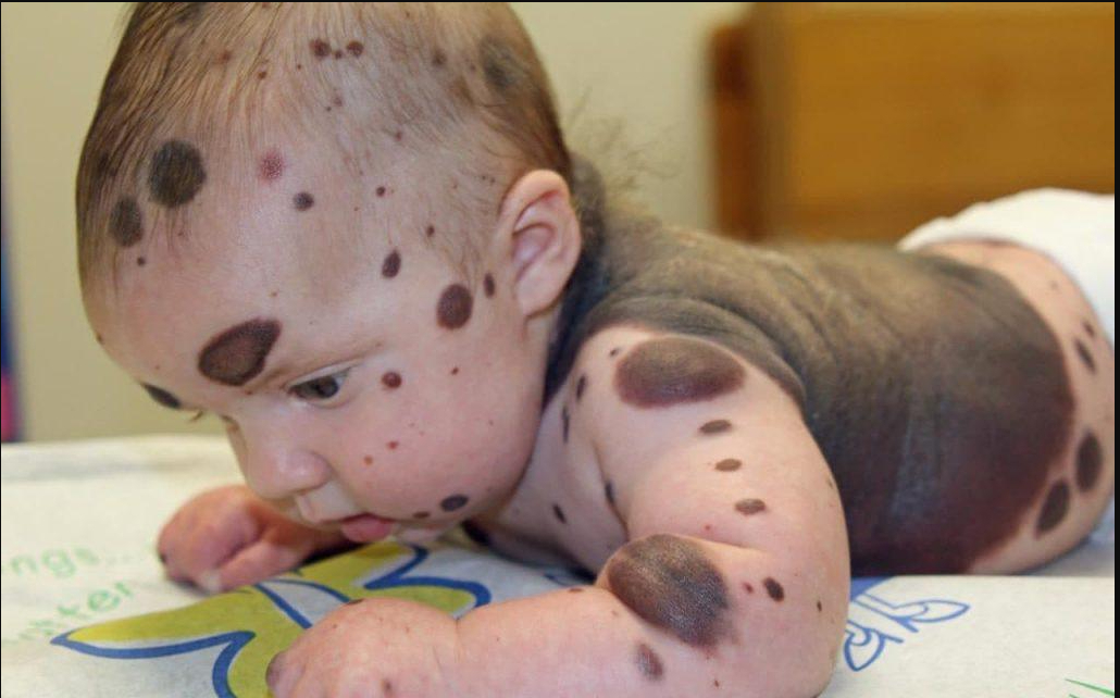 Dylan var dækket af store sorte pletter fra fødsel: Sådan ser han ud 7 år senere