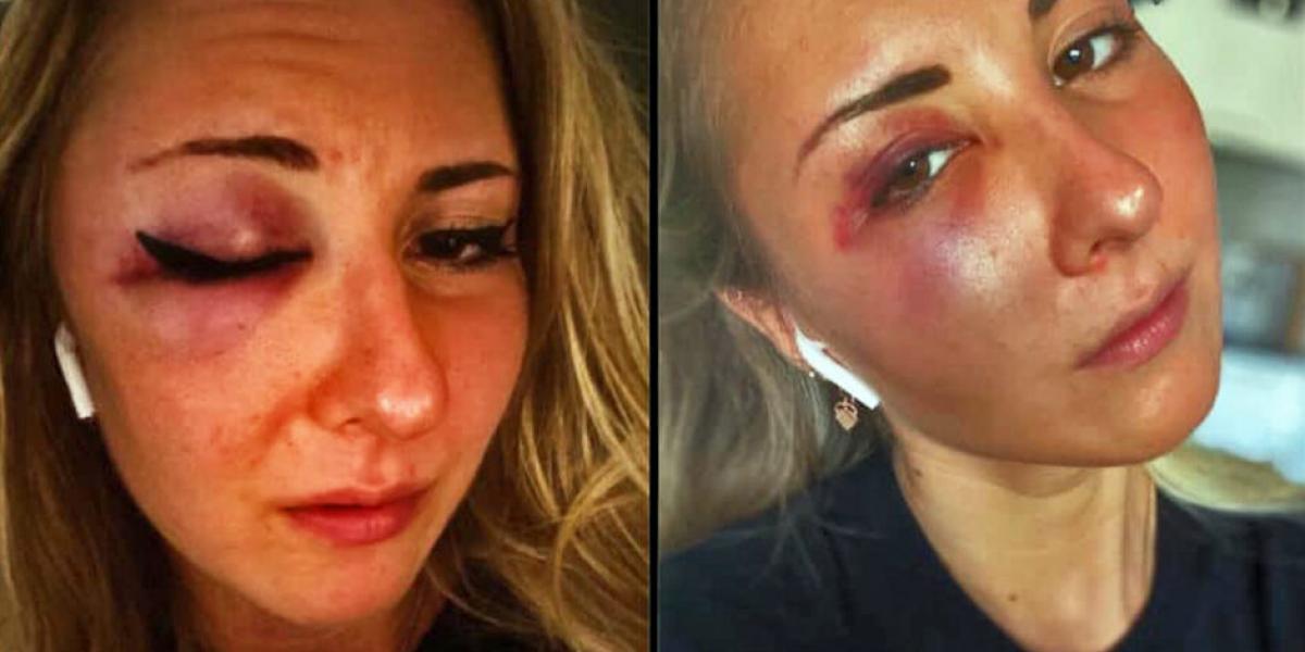 22-årige Elisabeth overfaldet af unge mænd: Hendes nederdel var ‘for kort’