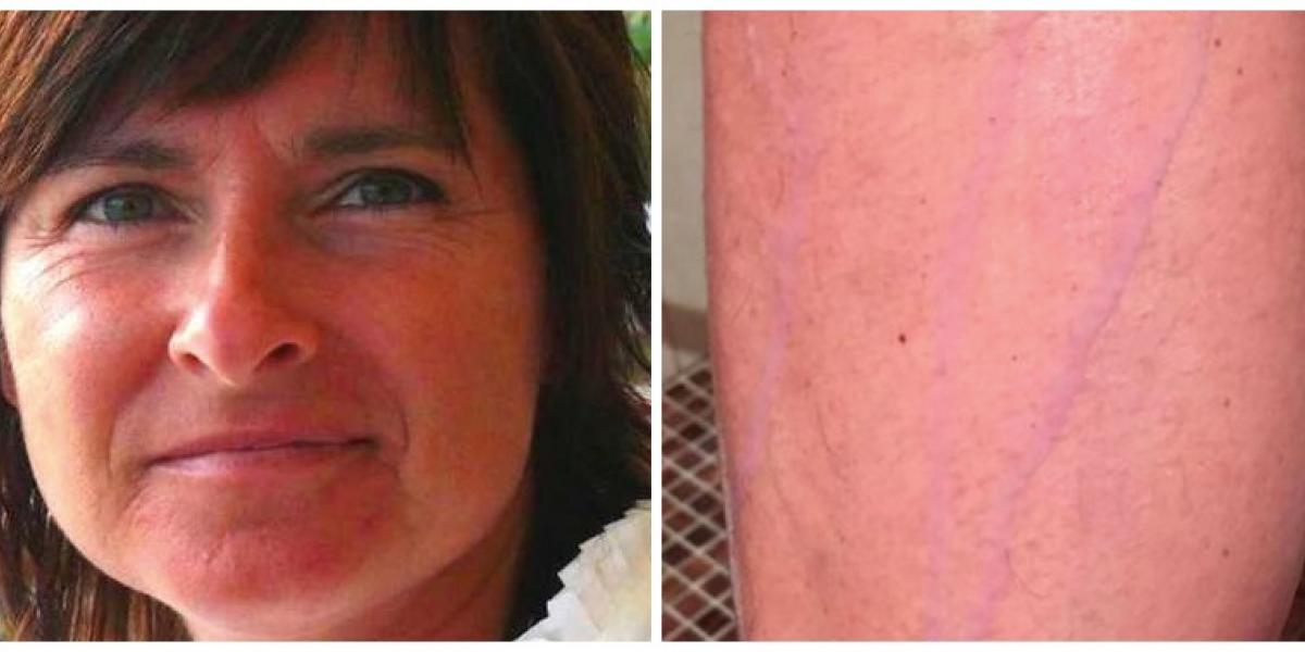 48-årige Maria havde købt nyt tøj – fik et chok i badet, da hun så sit ben