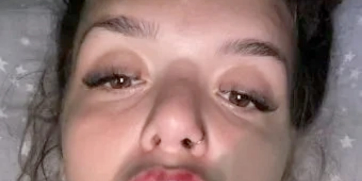 Kvinde fik filler i læben – og det gik helt galt: Nu viser hun resultatet