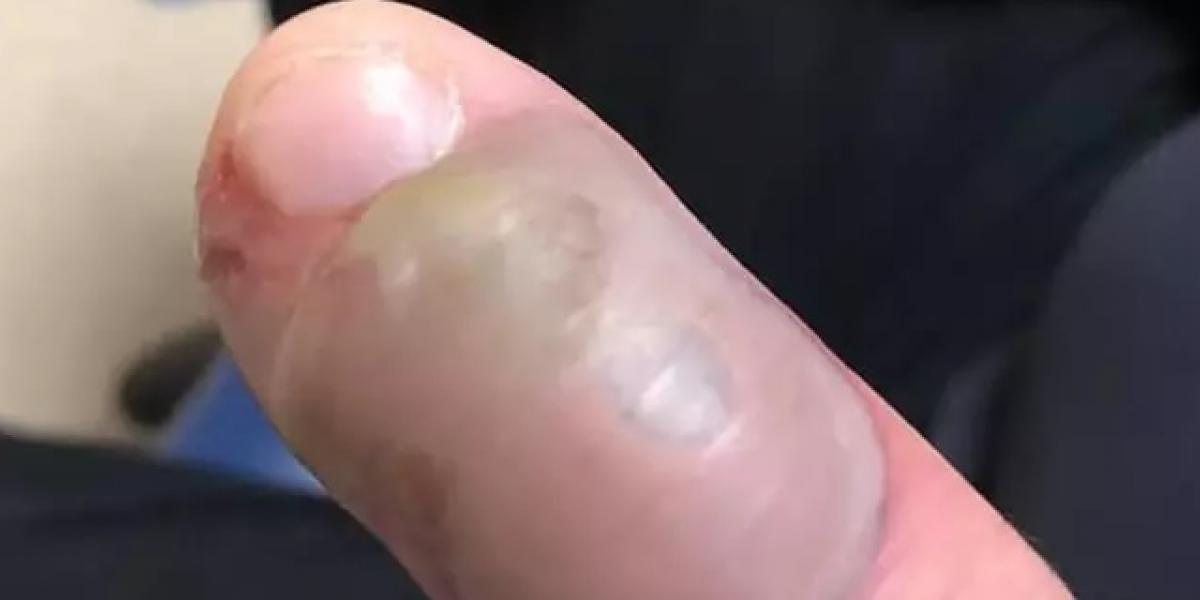 Tæt på at miste en finger: Kvinde advarer folk der bider negle