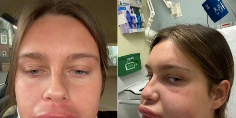 Kvinde indlagt på hospitalet: Gik helt galt, da hun ville fjerne lip fillers
