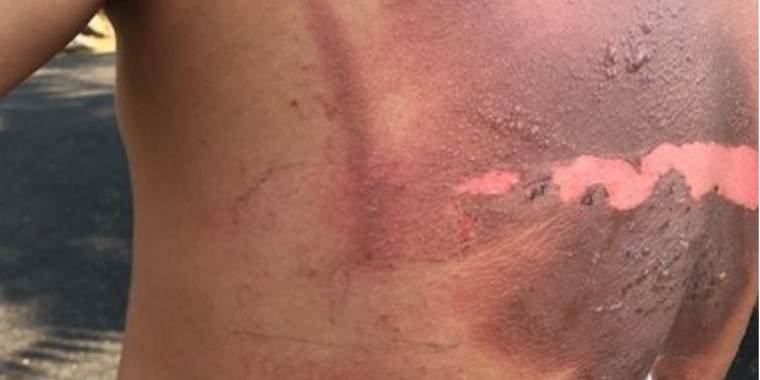 Oplader eksploderede i teenagers seng