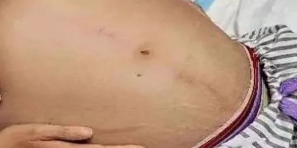 Kvinde havde så ondt i maven at hun måtte på hospitalet: Du får et chok, når du ser hvad de ‘trækker’ ud