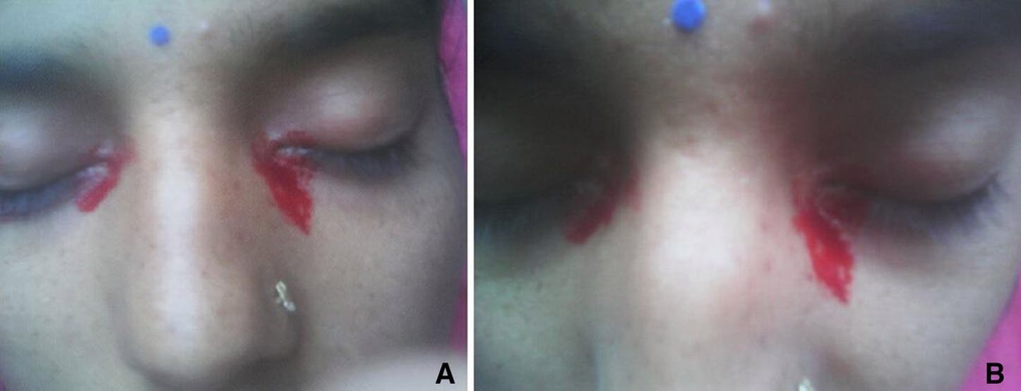 Underligt tilfælde: Græder blod under menstruation