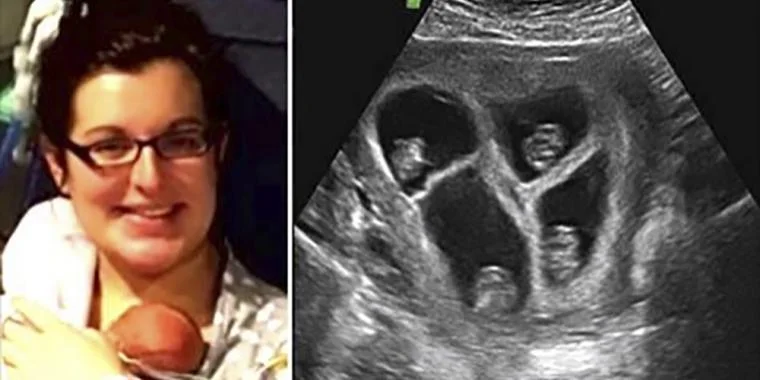 Gravid kvinde venter firlinger: Anden scanning afslører ufattelig detalje