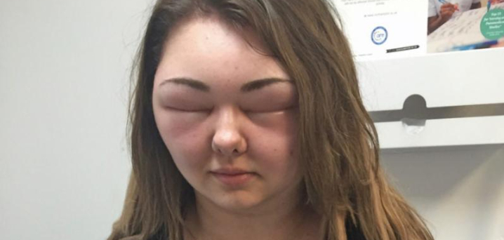 Indlagt efter hårfarvning: 24-årig kvindes ansigt svulmede helt op