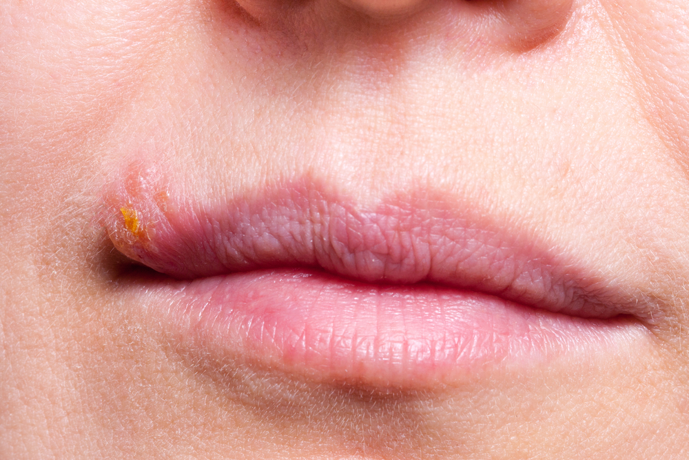 Herpes