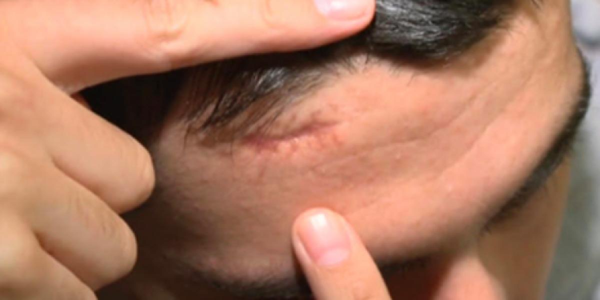 Han tog til lægen med sit livs værste hovedpine – blev rystet over fund i hjernen