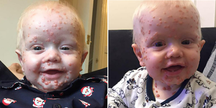 Troede at 4-årige Oscar havde fået skoldkopper: Viste sig at være meget værre