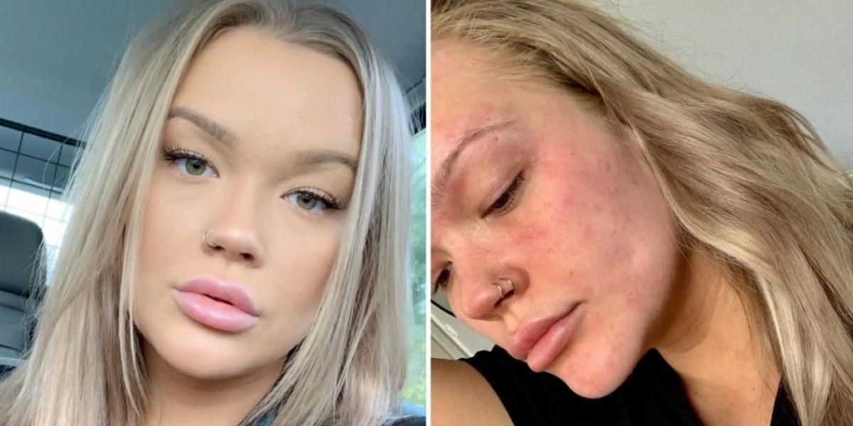 Isabella er allergisk overfor vand: ‘Folk tror jeg lyver’