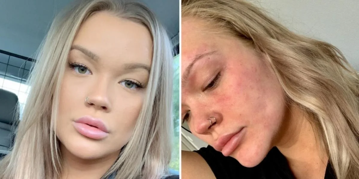 Isabella er allergisk overfor vand: ‘Folk tror jeg lyver’