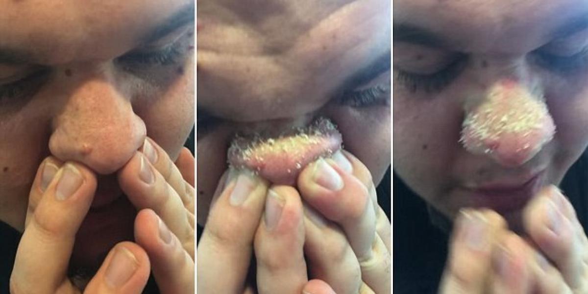 Jacob presser snesevis af hudorme på en gang med denne effektive metode