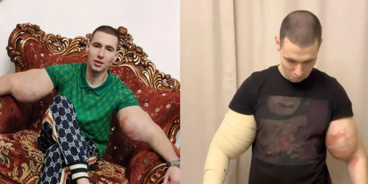 24-årig bodybuilder injicerede vaseline i musklerne: Risikerer at miste evnen til at bruge sine arme
