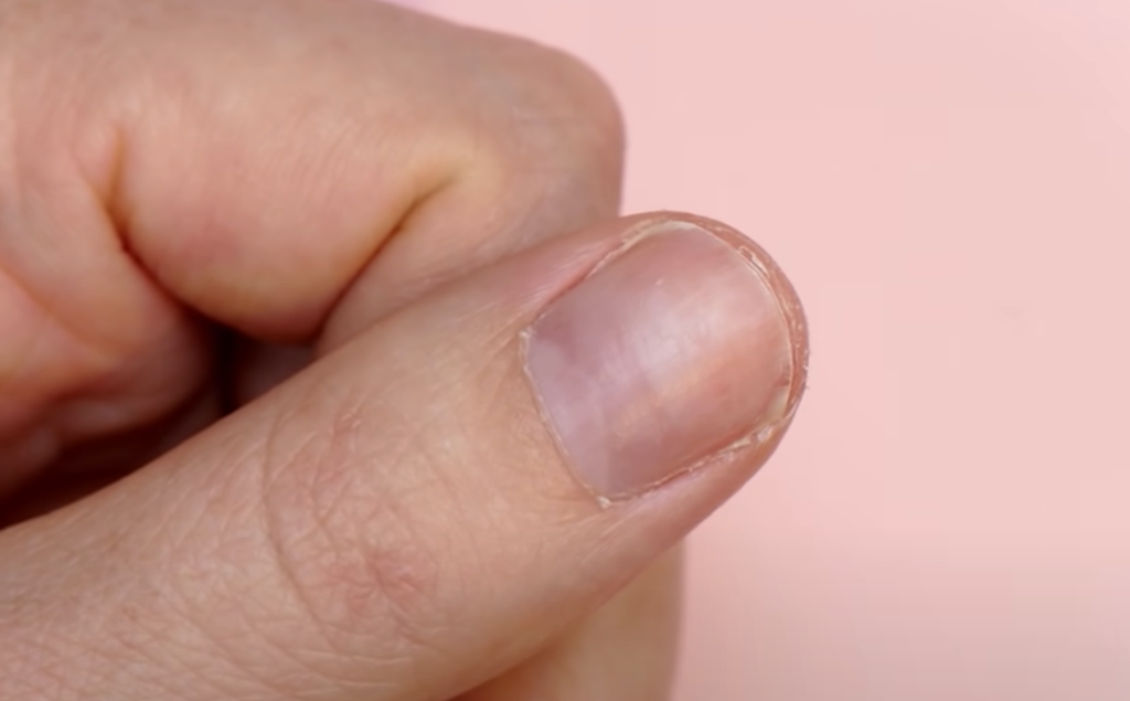 Eksperter slår alarm mod populær trend: Risikerer at udløse allergi hele livet