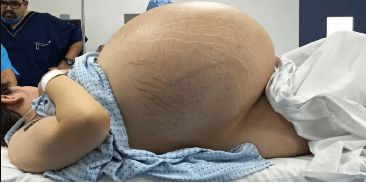 Alle tror kvinden er gravid: Scanning afslører en chokerende overraskelse