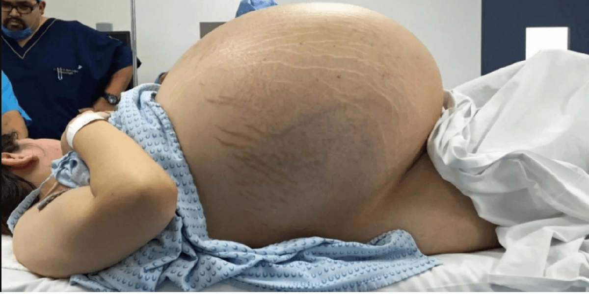 Alle tror kvinden er gravid: Scanning afslører en chokerende overraskelse