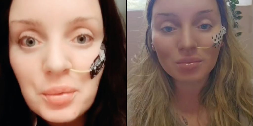 Louises operation gik helt galt: Nu skal hun have sondemad resten af livet