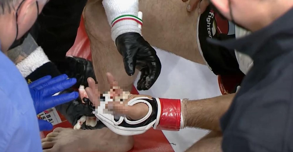 Chokerende video: MMA-kæmpers finger forsvinder under kamp