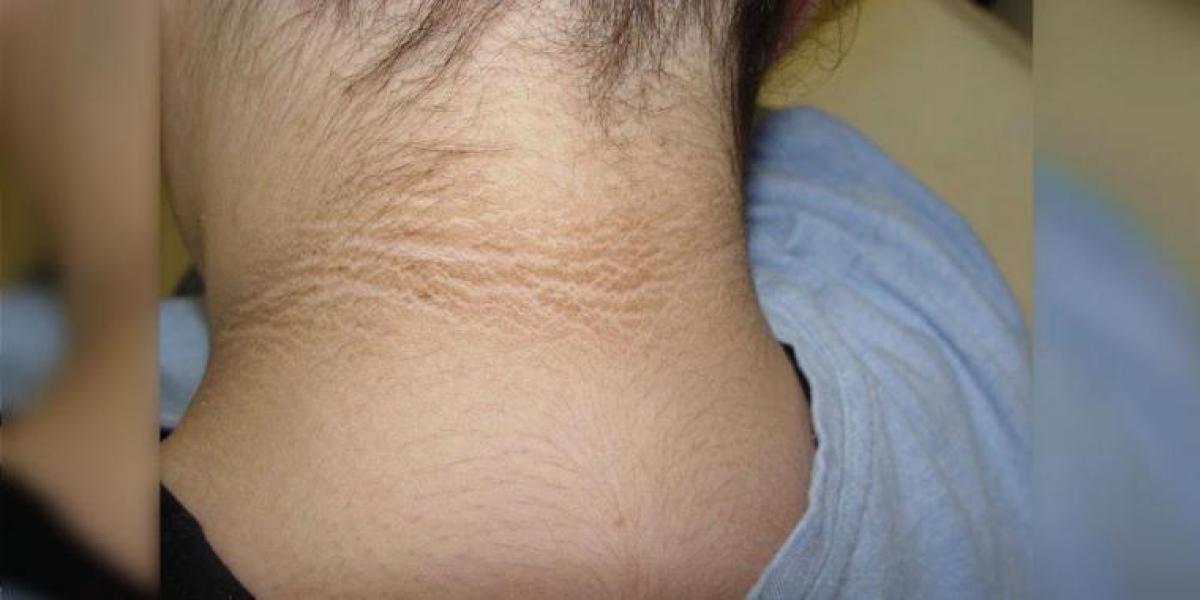 Mor lægger mærke til mørk ring på datterens hals, men havde aldrig forventet lægernes diagnose