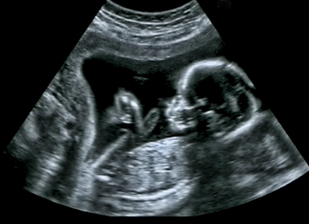 Nakkefoldsscanning