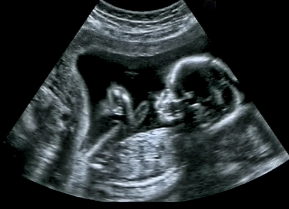 Nakkefoldsscanning