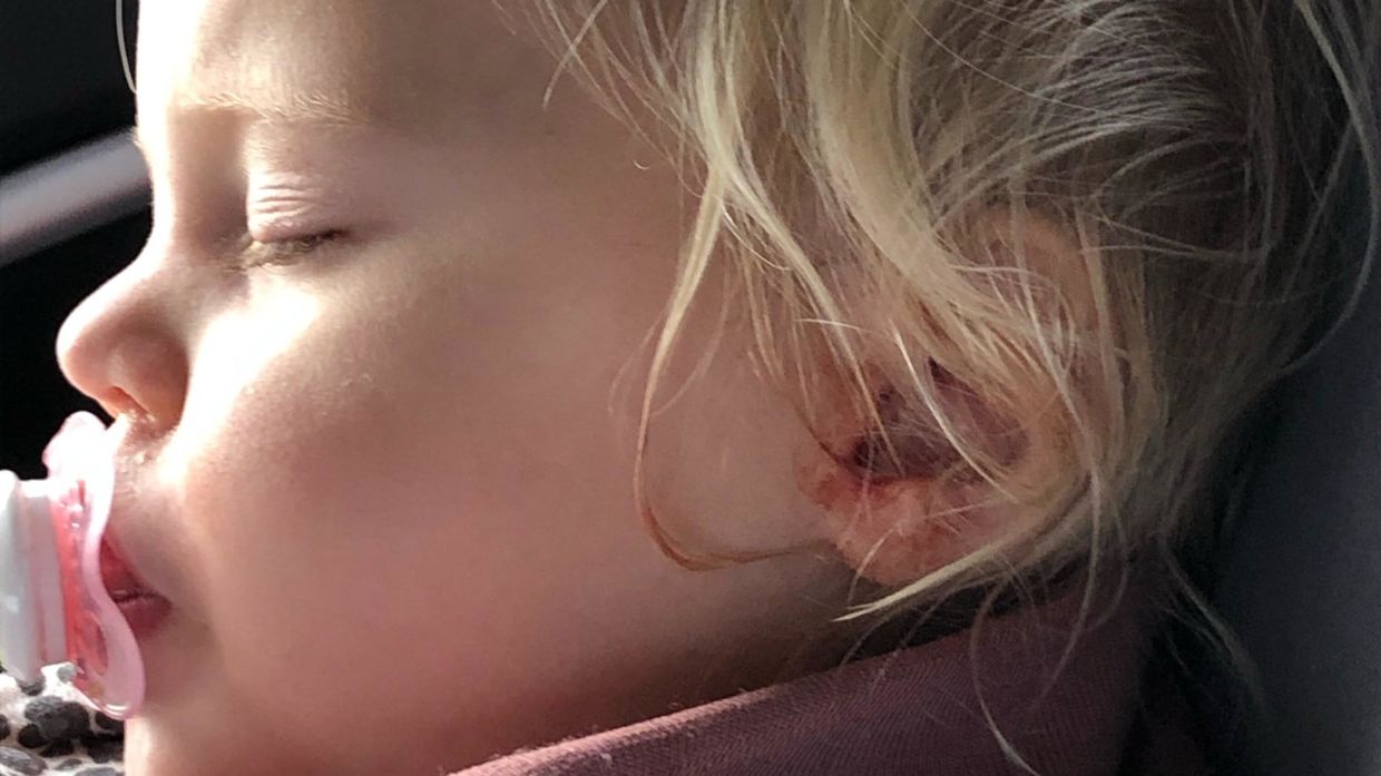 1-årig blødte kraftigt: Mor er rasende