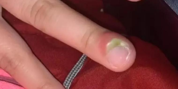 Teenager advarer neglebidere: Var tæt på at få amputeret sin finger