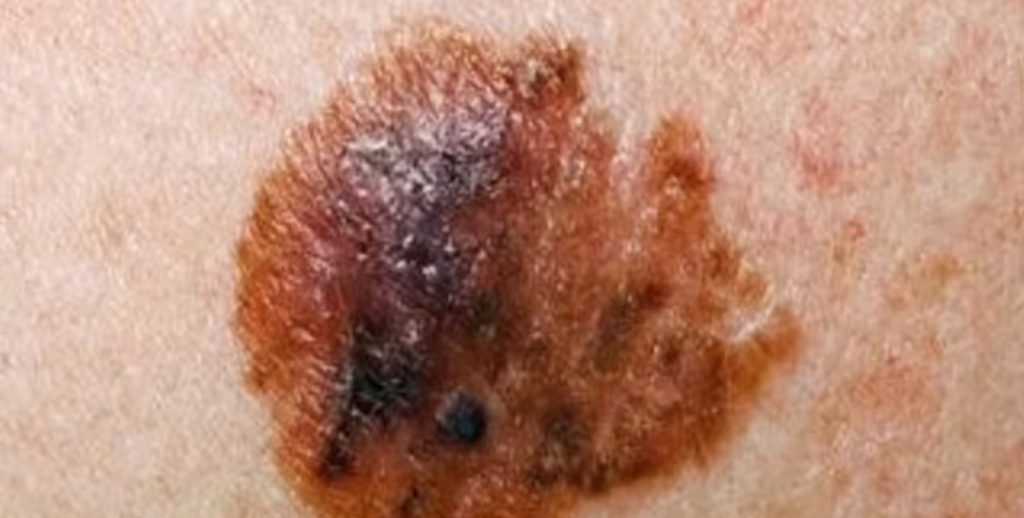 Sådan spotter du hudkræft efter sommeren: Sygeplejerske afslører ABCDE-hjemmetest