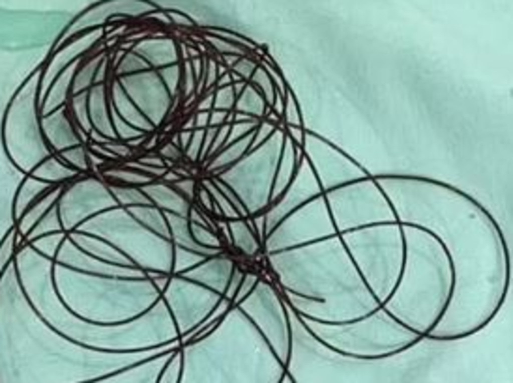 37-årig mand legede med sig selv: 2 meter lang snor endte med at sidde fast i ‘fidusen’