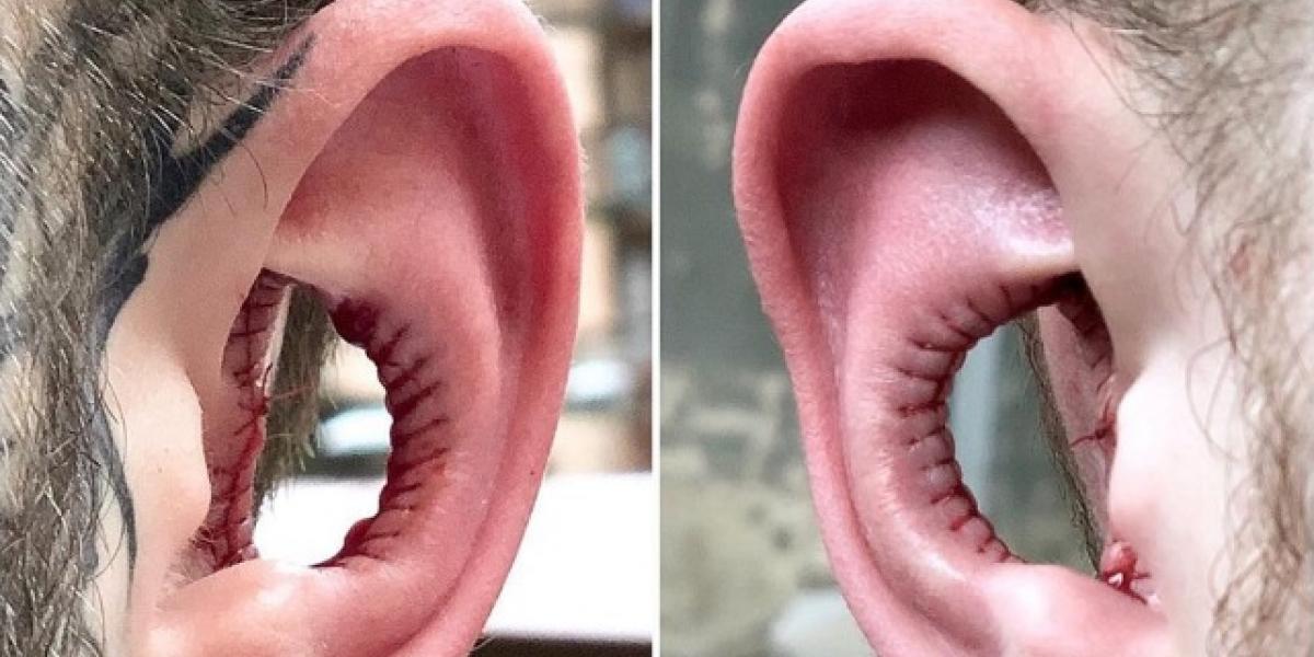 Folk får fjernet det inderste af deres øre i ny modetrend