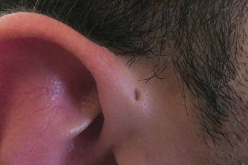 Forsker afslører: Derfor har nogle mennesker bittesmå huller over ørerne