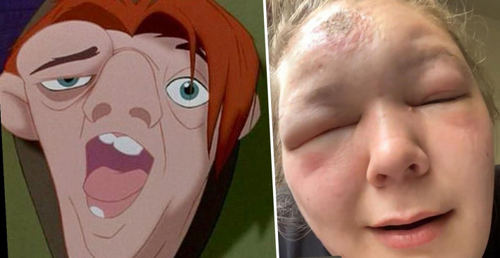 Sad to timer i 27 graders solskin: Nu ligner hun Quasimodo