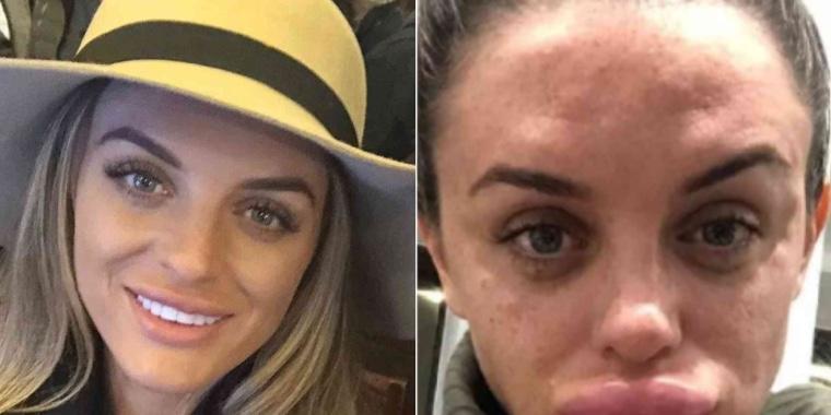 29-årig kvinde fik fillers i læberne: Nu viser hun, hvor galt det kan gå