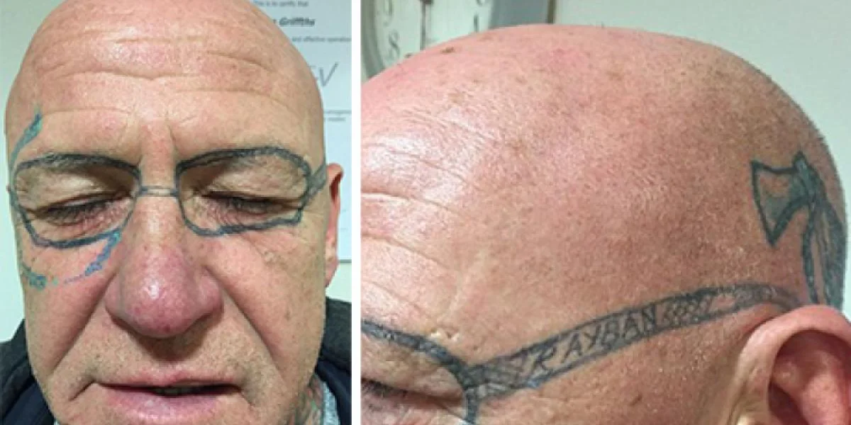 Mand vågner efter vild druktur med drengene med et par Ray Ban-solbriller tatoveret i sit ansigt