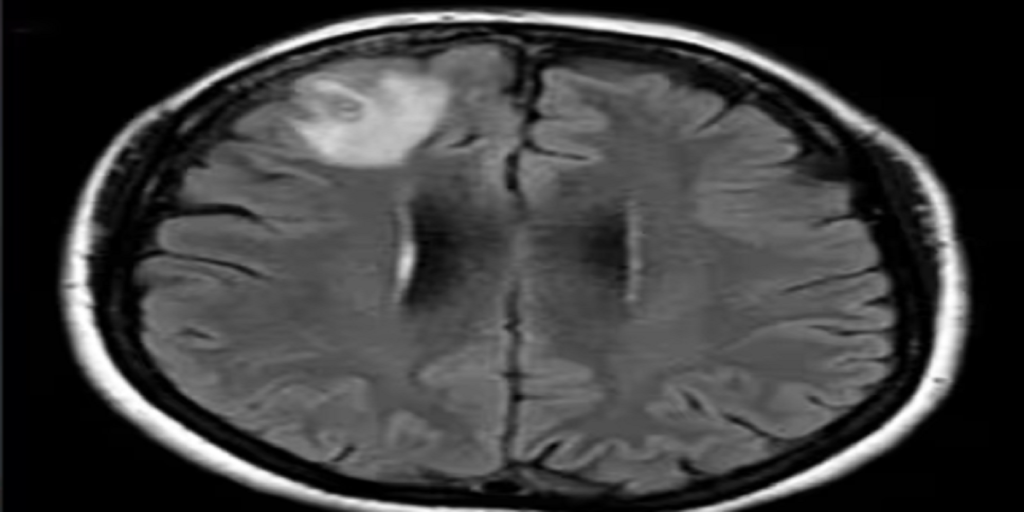 Kvinde led af glemsomhed og depression: Så gør lægerne chokerende fund i hendes hjerne
